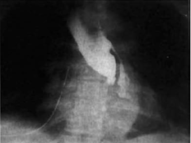 Contrast radiography shows contrast outflow from the lower esophageal region to the left.