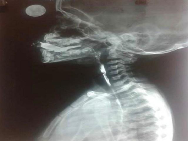 Barium swallow revealed a web in the hypopharynx at the level of C4-C5 vertebral bodies.